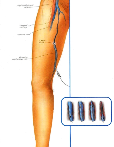 Diodowy laser chirurgiczny